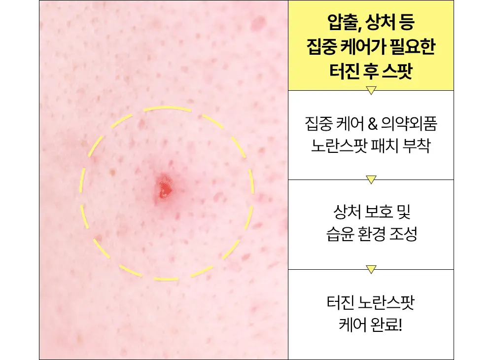 [올영단독] 해서린 스팟케어 패치 단품 (붉은스팟, 노란스팟) 상세페이지 21